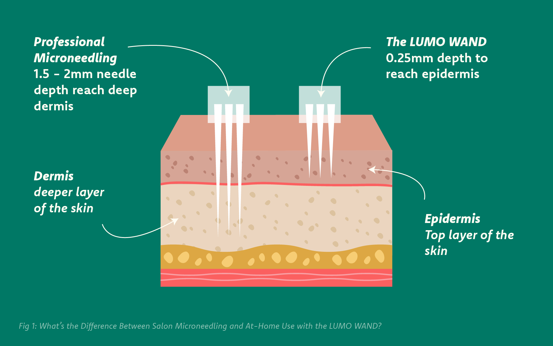 skincare definitions - Microneedling uses fine needles to create tiny micro-channels in the skin, stimulating collagen and elastin production for firmer, smoother skin.